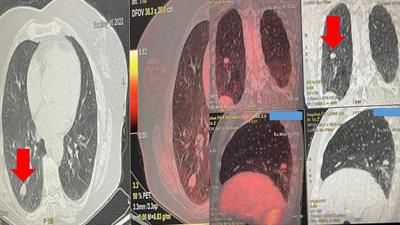 Case Report: Endoscopic radiofrequency ablation with radial-EBUS and ROSE